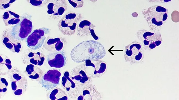 Буквально съедает мозг. Зафиксирован новый случай опасной инфекции